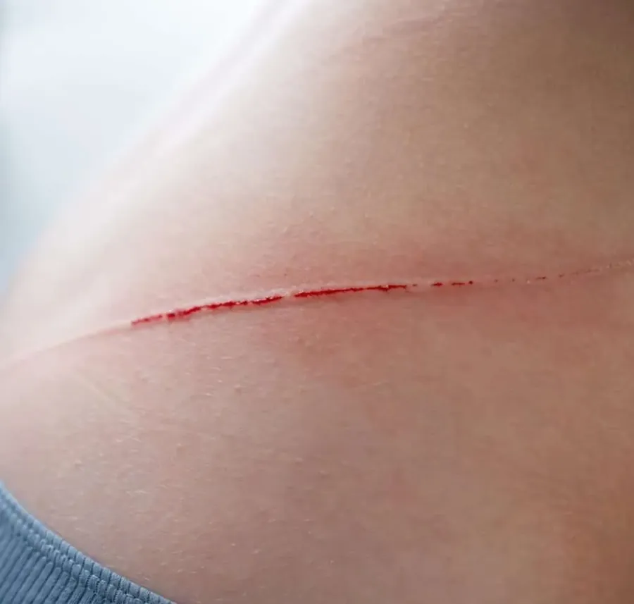 Lacerations treatment at WellHealth Medical Associates in Rochester Hills, MI